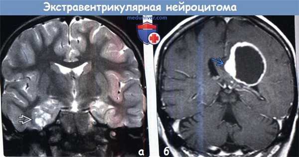 Экстравентрикулярная нейроцитома на МРТ