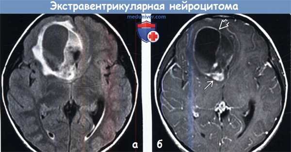 Экстравентрикулярная нейроцитома на МРТ