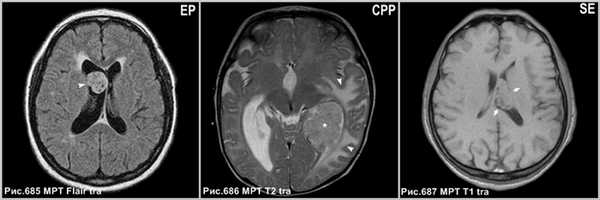 central_neurocytoma_4