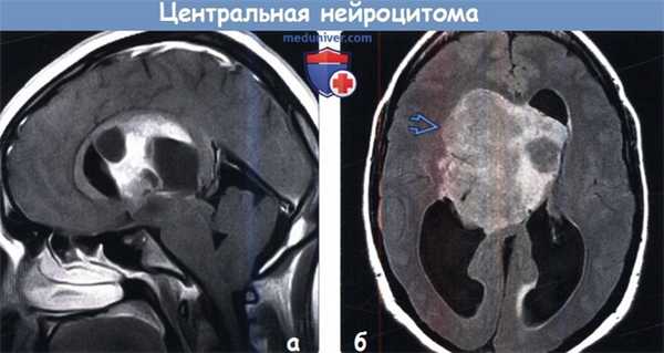 Центральная нейроцитома на МРТ