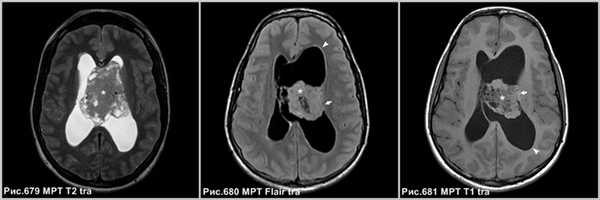 central_neurocytoma_2
