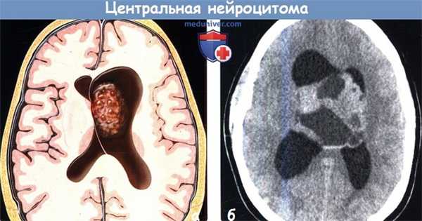Центральная нейроцитома на КТ