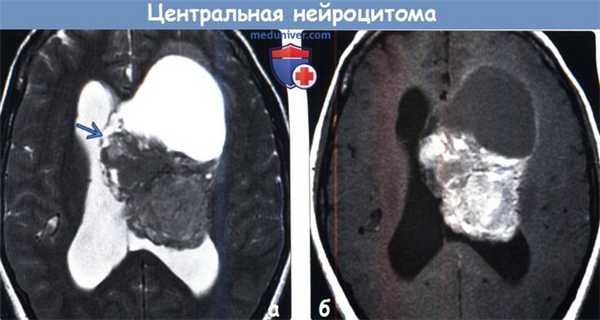 Центральная нейроцитома на МРТ