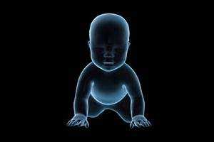 Клинико-рентгенологическая диагностика и лечение редкой формы эпифизарной дисплазии - гемимелической эпифизарной дисплазии