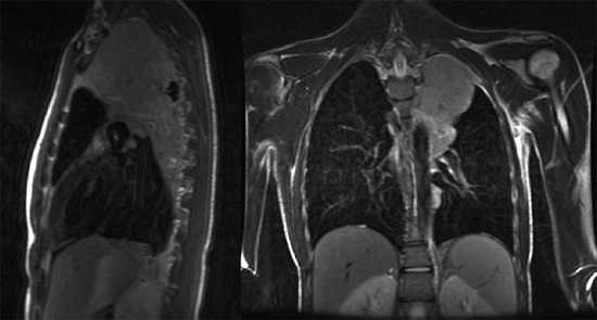 МРТ грудной клетки