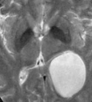 Ependimal cyst