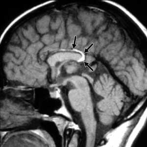 glipoma_cns_fig2a