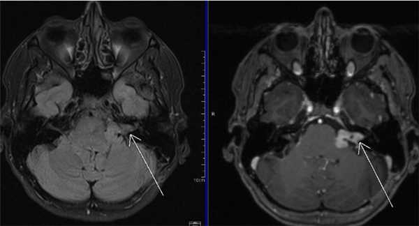 В аксиальной плоскости отмечается повышение интенсивности МР-сигнала в области ячеек сосцевидного отростка левой височной кости