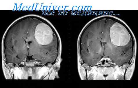метастазы в спинной мозг