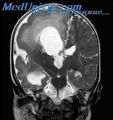 эпилептический автоматизм