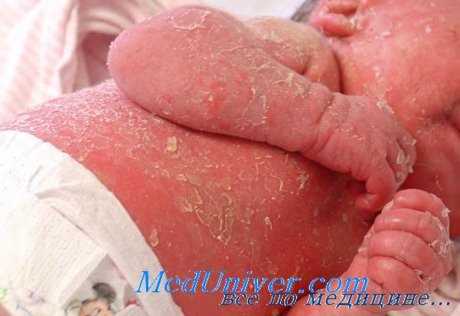 эритродермия