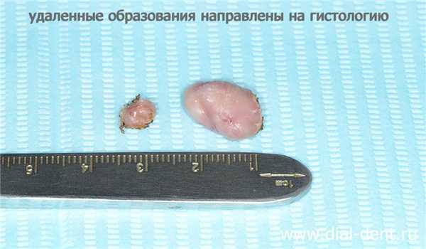 после удаления фибромы рта ткани отправляются на гистологическое исследование