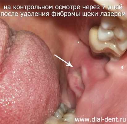 на контрольном визите через 7 дней после удаления фибромы