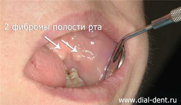 две фибромы рта на щеке