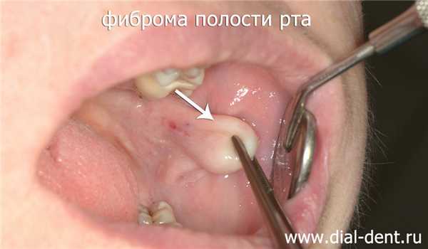 фиброма щеки