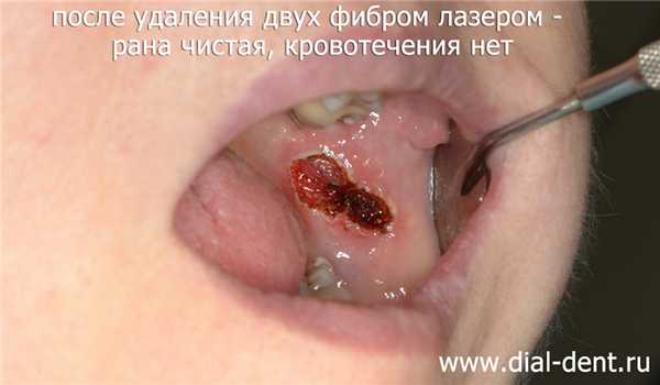 сразу после удаления фибромы рта лазером - нет кровотечения, рана аккуратная