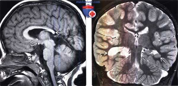 Аномалии развития гипофиза на МРТ головного мозга