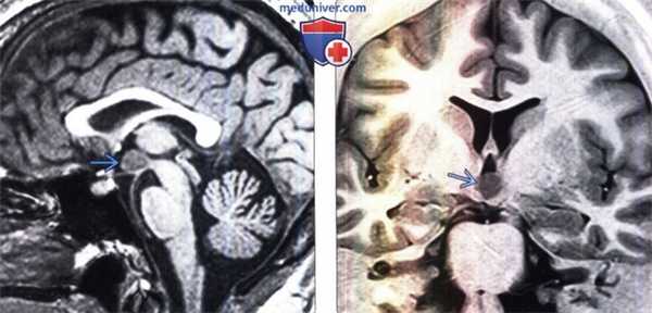 Гамартома гипоталамуса на МРТ