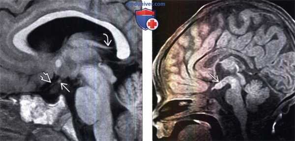 Аномалии развития гипофиза на МРТ головного мозга