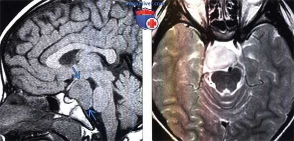 Гамартома гипоталамуса на МРТ