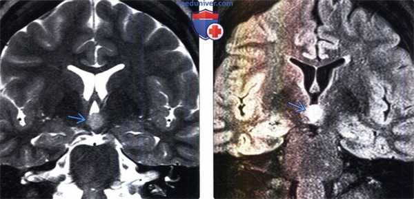 Гамартома гипоталамуса на МРТ