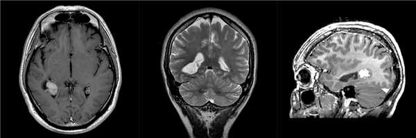 МРТ признаки ганглиоглиомы