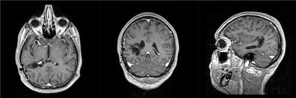 Успешное хирургическое лечение ганглиоглиомы