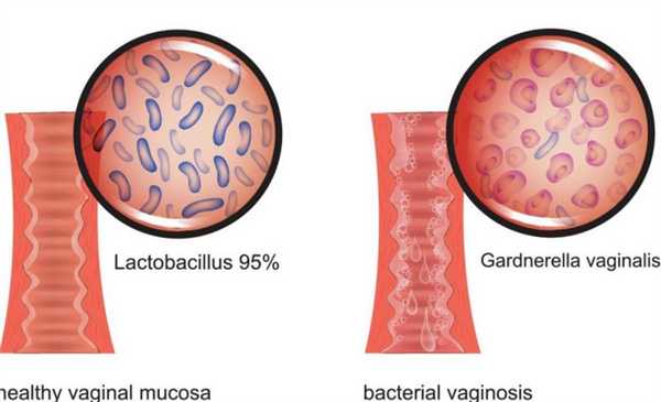 гарднерелла