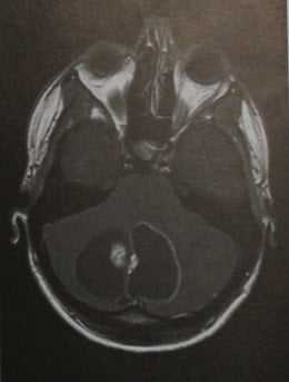Снимки МРТ и КТ. Гемангиобластома