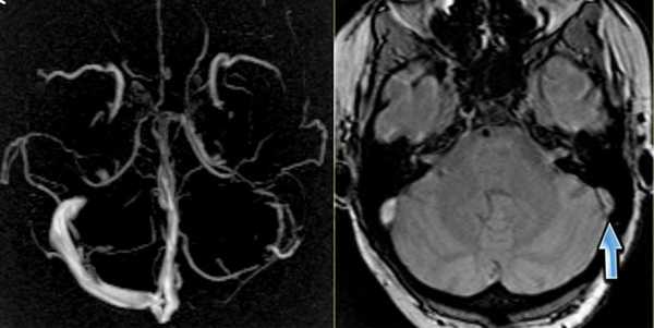 Применение МРТ в исследовании вен головного мозга