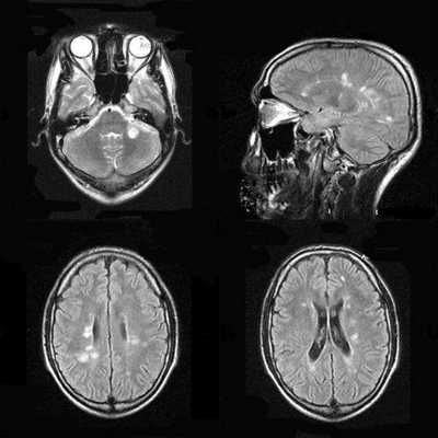 При переходе воспаления на стенки желудочков мозга, виден отек их и усиление сигнала. Такое поражение характерно для энцефалита, вызванного вирусом эпидемического паротита