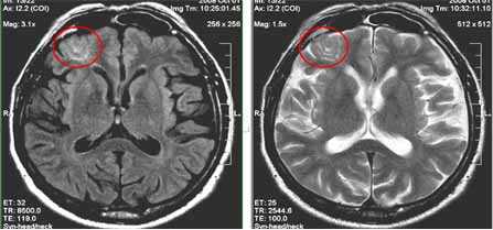 МРТ у больных с эпилепсией: клинические случаи