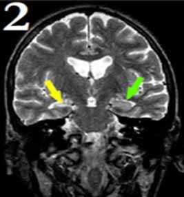 МРТ у больных с эпилепсией: клинические случаи