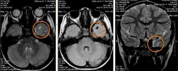 МРТ у больных с эпилепсией: клинические случаи