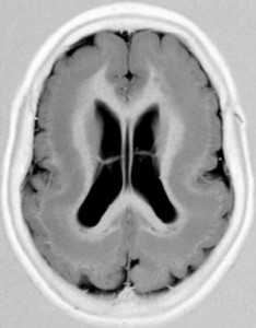 gband_heterotopia_fig2a