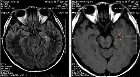 МРТ у больных с эпилепсией: клинические случаи