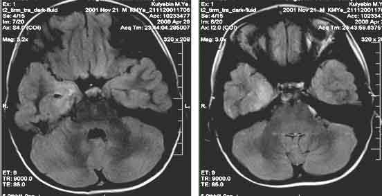 МРТ у больных с эпилепсией: клинические случаи