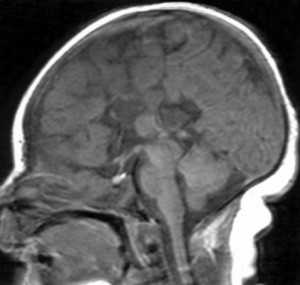 gaicardi_syndrome_fig1a