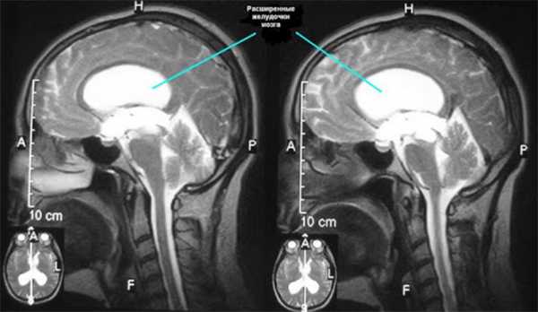 МРТ головного мозга. На МР-томограмме в сагиттальной плоскости отмечается расширение боковых желудочков мозга