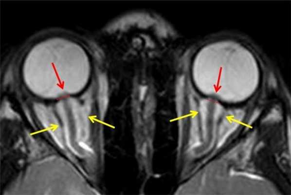 МРТ орбит. На МРТ орбит в аксиальной плоскости отмечается минимально выраженный отек ретробульбарной клетчатки