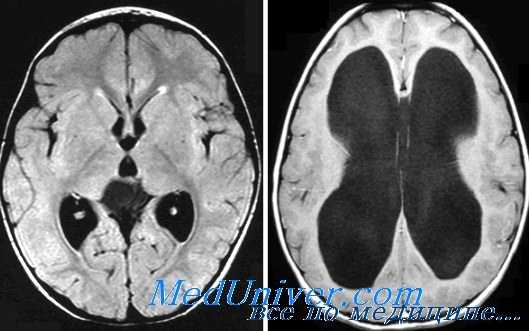 диагностика гидроцефалии