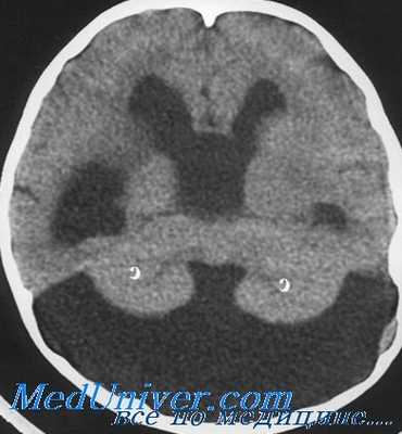 лечение гидроцефалии