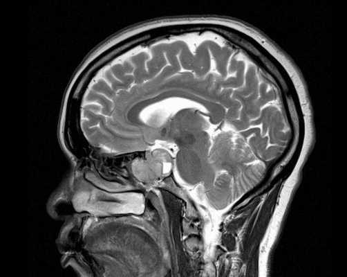 Опухоль гипофиза на снимке МРТ