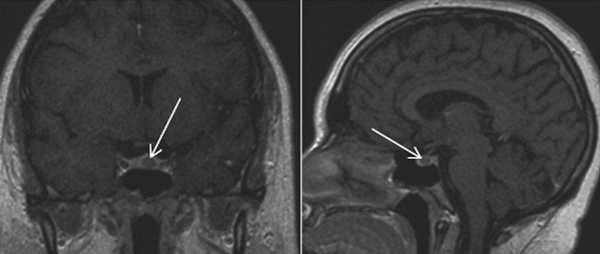 Микроаденома гипофиза на снимке МРТ