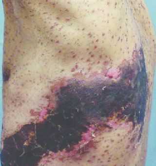 Гангренозный опоясывающий герпес