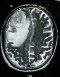 глиобластома томография