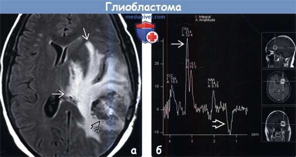 Глиобластома на МРТ