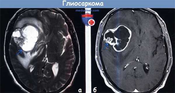 Глиосаркома на МРТ
