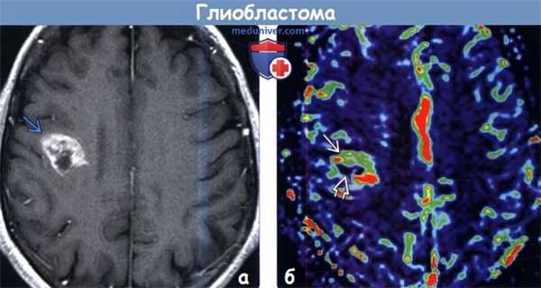 Глиобластома на МРТ