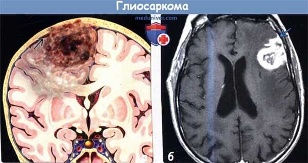 Глиосаркома на МРТ